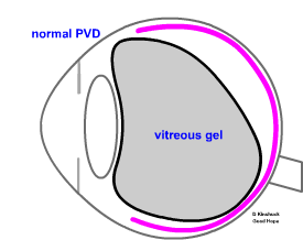 a normal PVD
