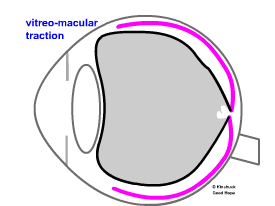as the vitresou detaches it pulls the retina