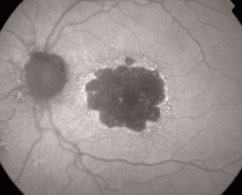 www.vrmny.com...autofluorescence of the retina